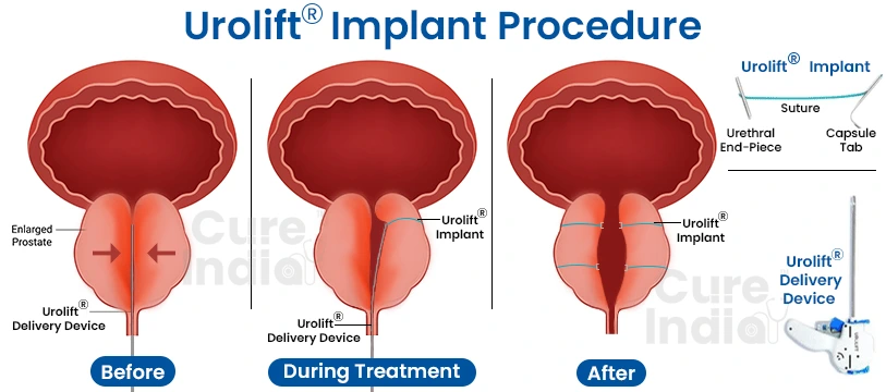 procedure for UroLift treatment in India